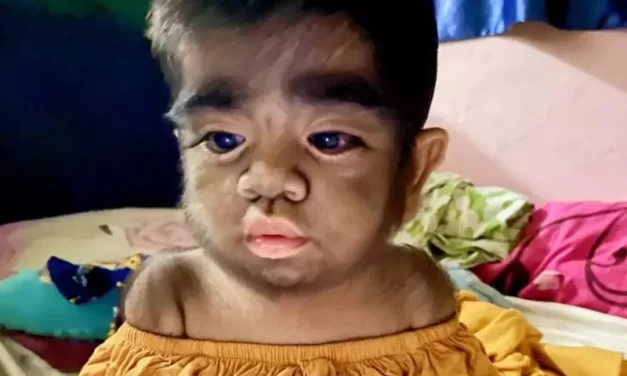 Nascimento de bebês com ‘síndrome de lobisomem’ acende alerta vermelho sobre uso de minoxidil