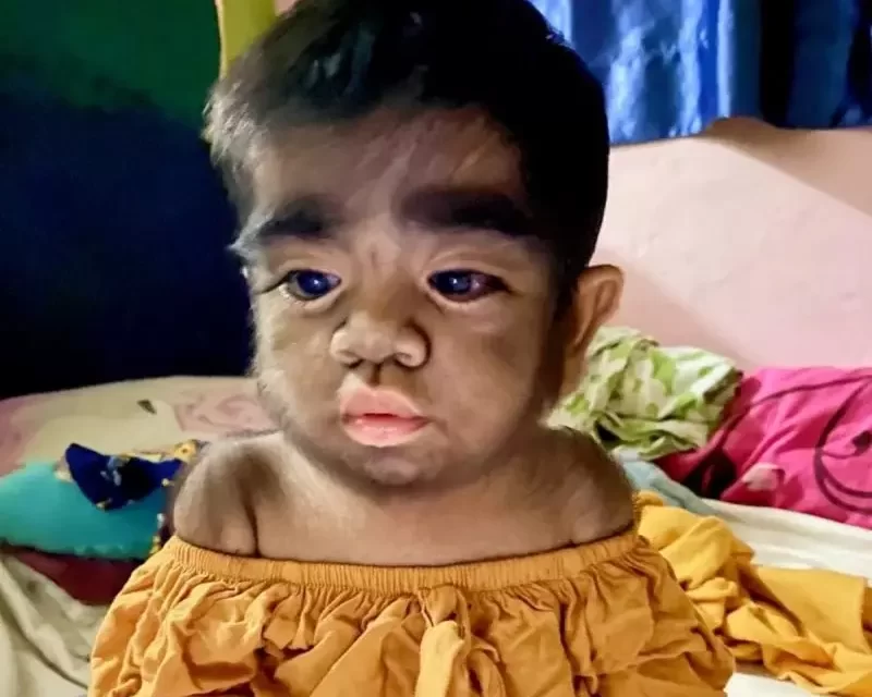 Nascimento de bebês com ‘síndrome de lobisomem’ acende alerta vermelho sobre uso de minoxidil