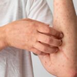 Brasil já registrou 88 casos do vírus Mpox em 2026; saiba como evitar a doença