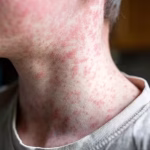 São Paulo tem primeiro caso de sarampo em 2026