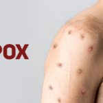 Cuiabá emite alerta epidemiológico para mpox e reforça vigilância