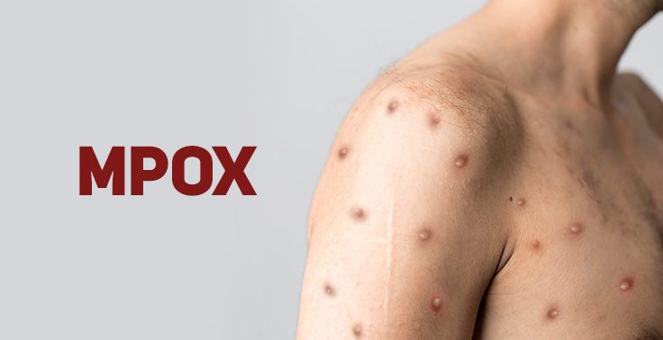 Cuiabá emite alerta epidemiológico para mpox e reforça vigilância