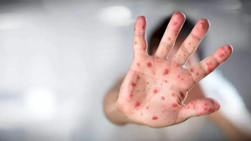 Mato Grosso registra 53 casos de meningite; 51% são crianças e adolescentes